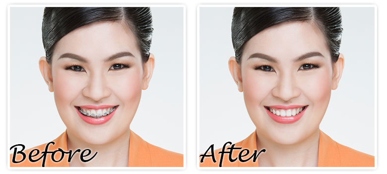 รีทัชเหล็กดัดฟันสำหรับถ่ายภาพสมัครแอร์สจ๊วต